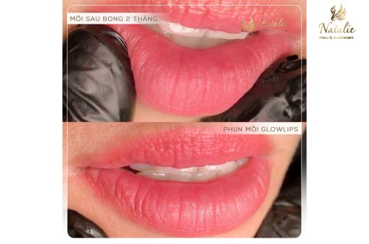 Dịch vụ phun môi Glowlips  | Thế Giới Skin Care